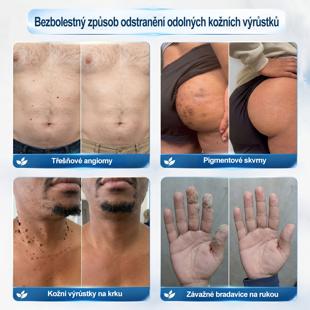 Oficiální značkový obchod |✅️👩‍⚕️𝐏𝐢𝒄𝒅𝒐® 7 dní Odstraňovač kožních skvrn a kožních výrůstků(Bezbolestný rollerball bez jizev)🌱